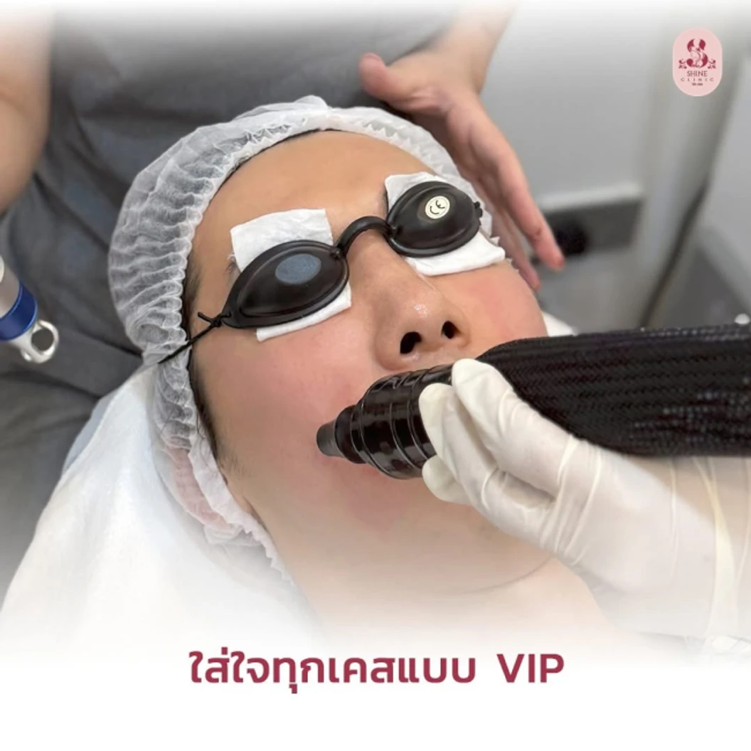 โปรแกรมโบท็อกซ์ 100 ยูนิต (หน้า)