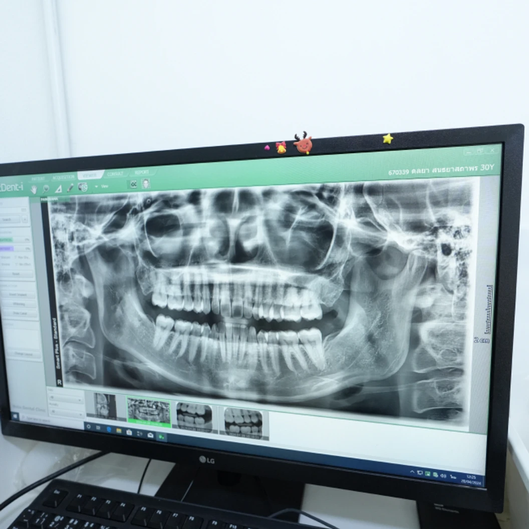 จัดฟันแบบใส Invisalign Full Comprehensive ฟันบนและล่าง (แบบ 3 ปี)