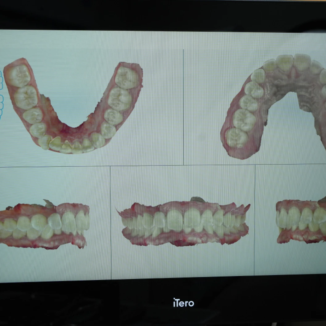 จัดฟันแบบใส Invisalign Full Comprehensive ฟันบนและล่าง (แบบ 3 ปี)