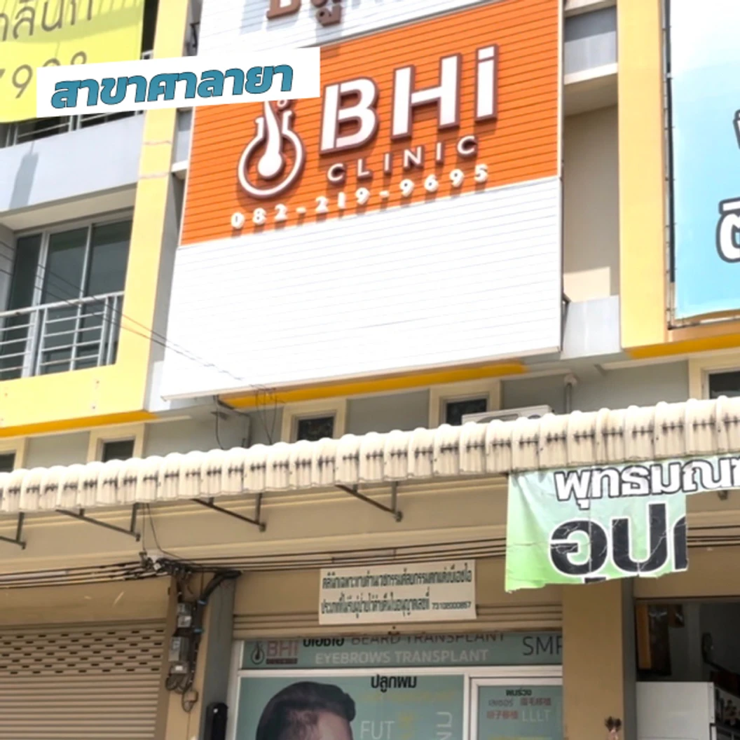 ปลูกผมเทคนิค FUE จำนวนกราฟต์ขึ้นอยู่กับแพทย์ประเมิน
