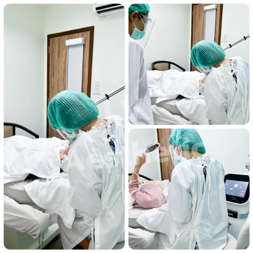 คอร์สเลเซอร์ Pico Tech ลบรอยสักคิ้ว 2 ข้าง 10 ครั้ง
