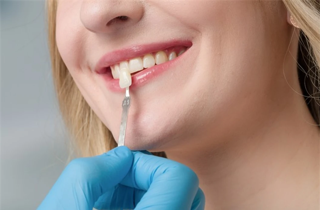 ทำวีเนียร์แบบเรซินคอมโพสิต 1 ซี่