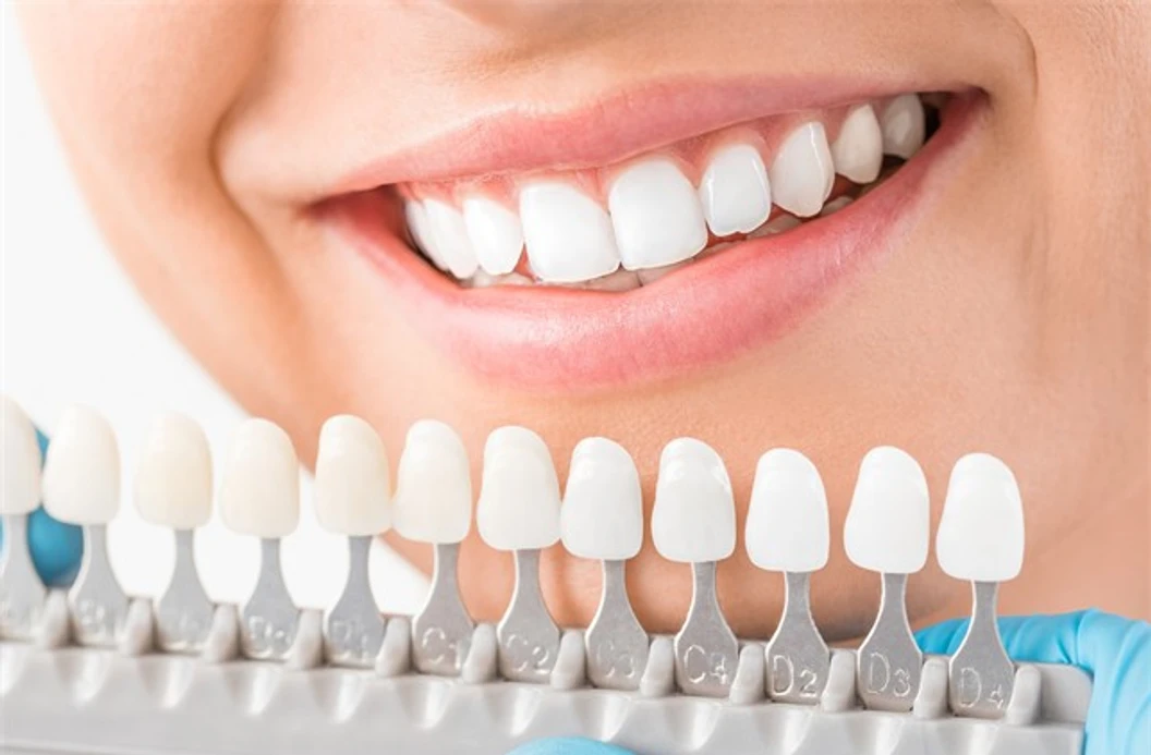 เคลือบผิวฟันและแปะฟันขาว ด้วยวีเนียร์คอมโพสิต 1 ซี่