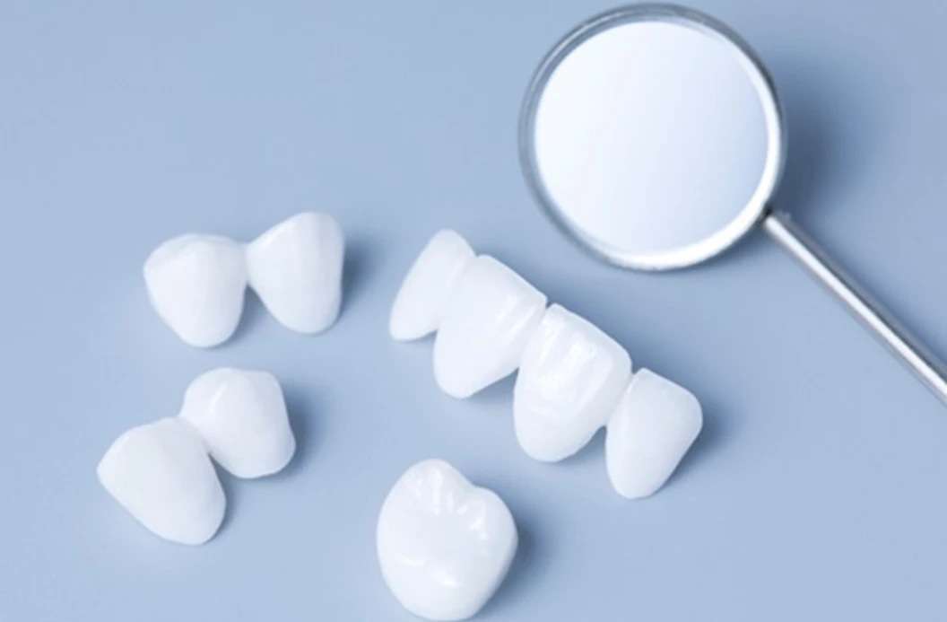 เคลือบผิวฟันและแปะฟันขาว ด้วยวีเนียร์เซรามิกหรือพอร์ซเลน EMax 1 ซี่