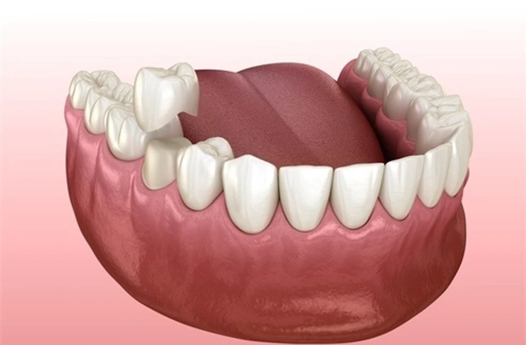 ทำครอบฟัน Zirconia สำหรับฟัน 1 ซี่