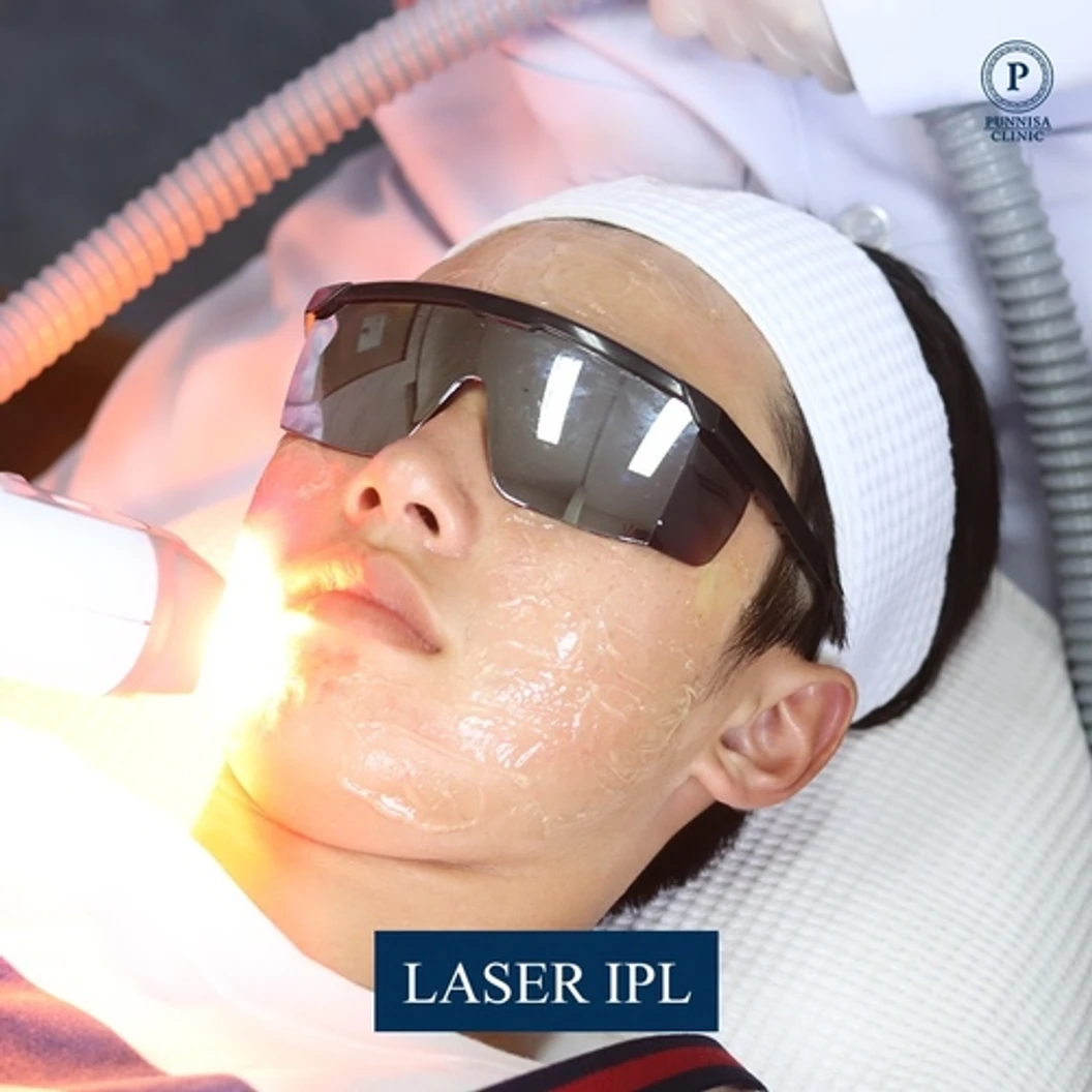 กำจัดขนหนวดด้วย IPL 1 ครั้ง