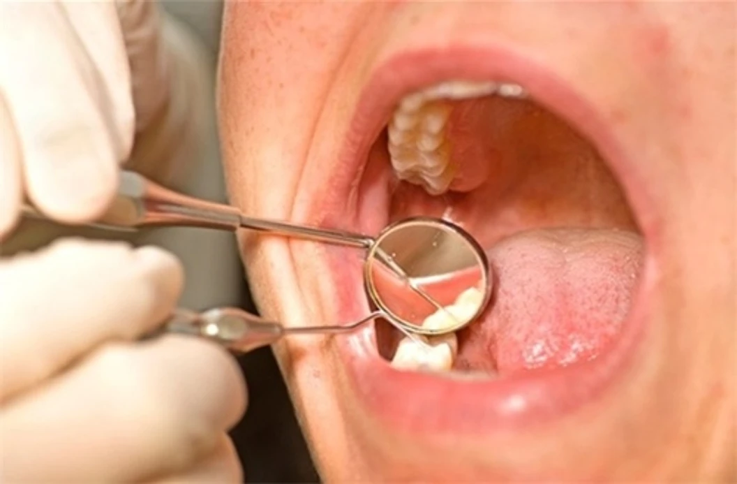 รักษารากฟันกรามใหญ่ 1 ซี่