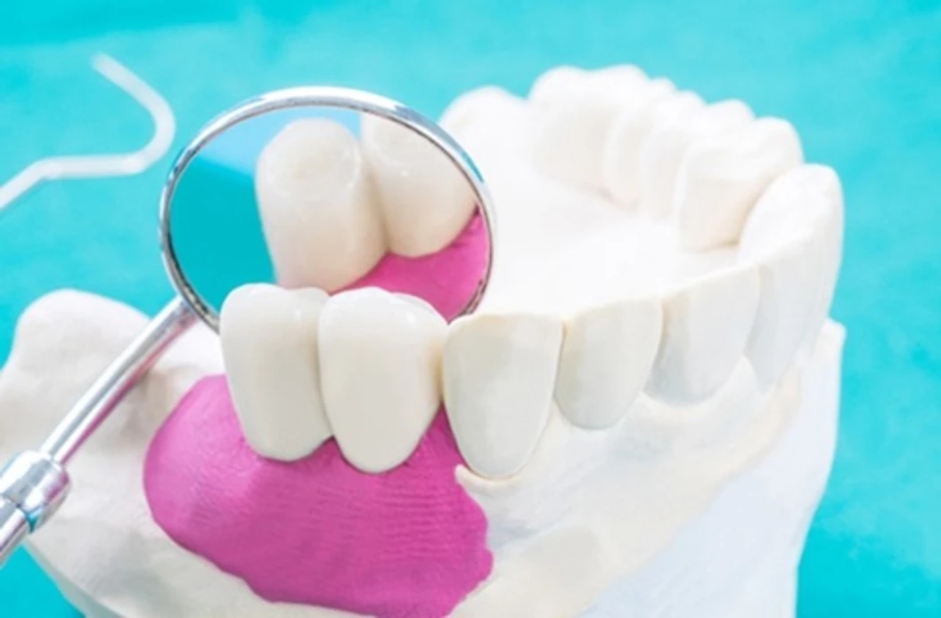 รักษารากฟันกรามน้อย 1 ซี่ (ตามแพทย์ประเมิน)