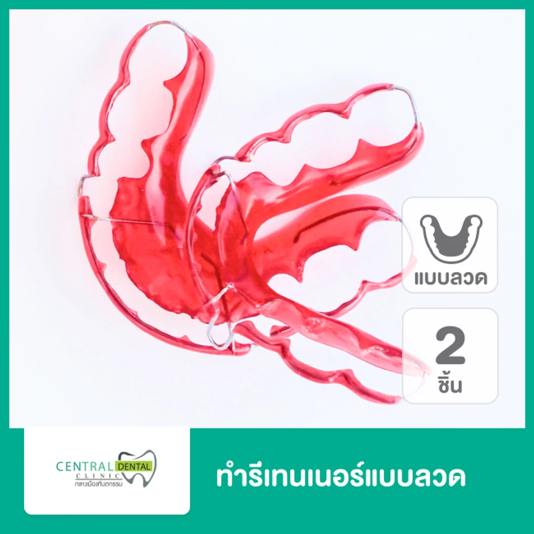 ทำรีเทนเนอร์แบบลวด 2 ชิ้น ฟันบนและล่าง
