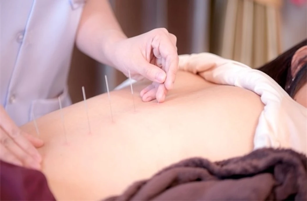 ฝังเข็มศาสตร์แพทย์จีน บรรเทา 1 อาการ TCM BASIC 10 ครั้ง