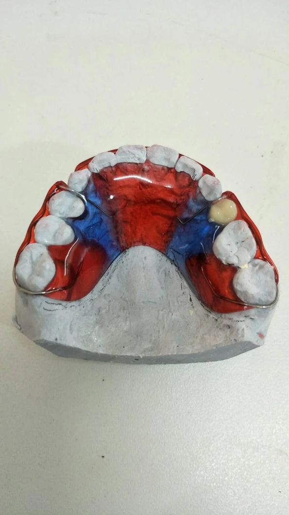 ทำรีเทนเนอร์แบบลวด 1 ชิ้น ฟันบนหรือล่าง