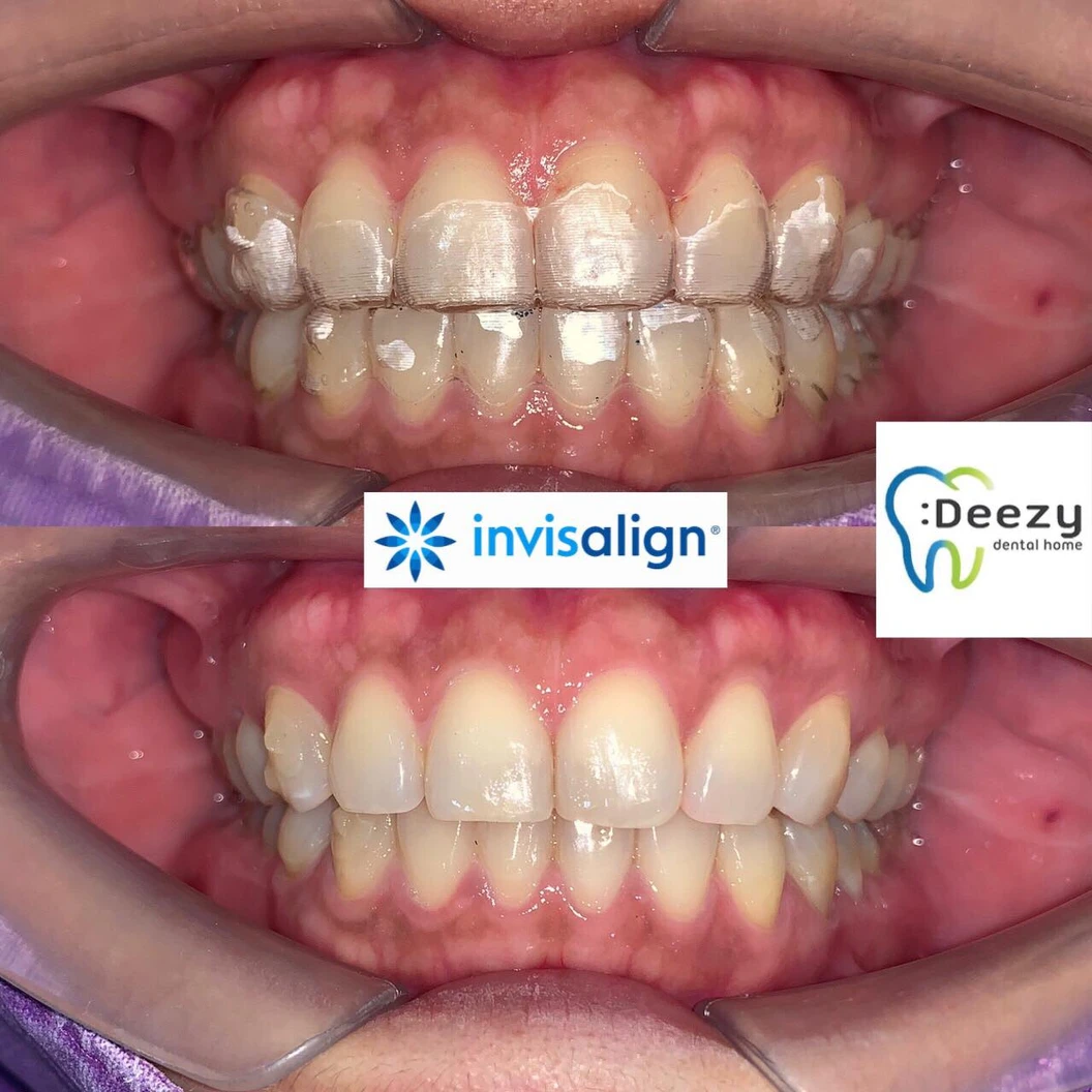 จัดฟันใส Invisalign Full Comprehensive ฟันบนและล่าง