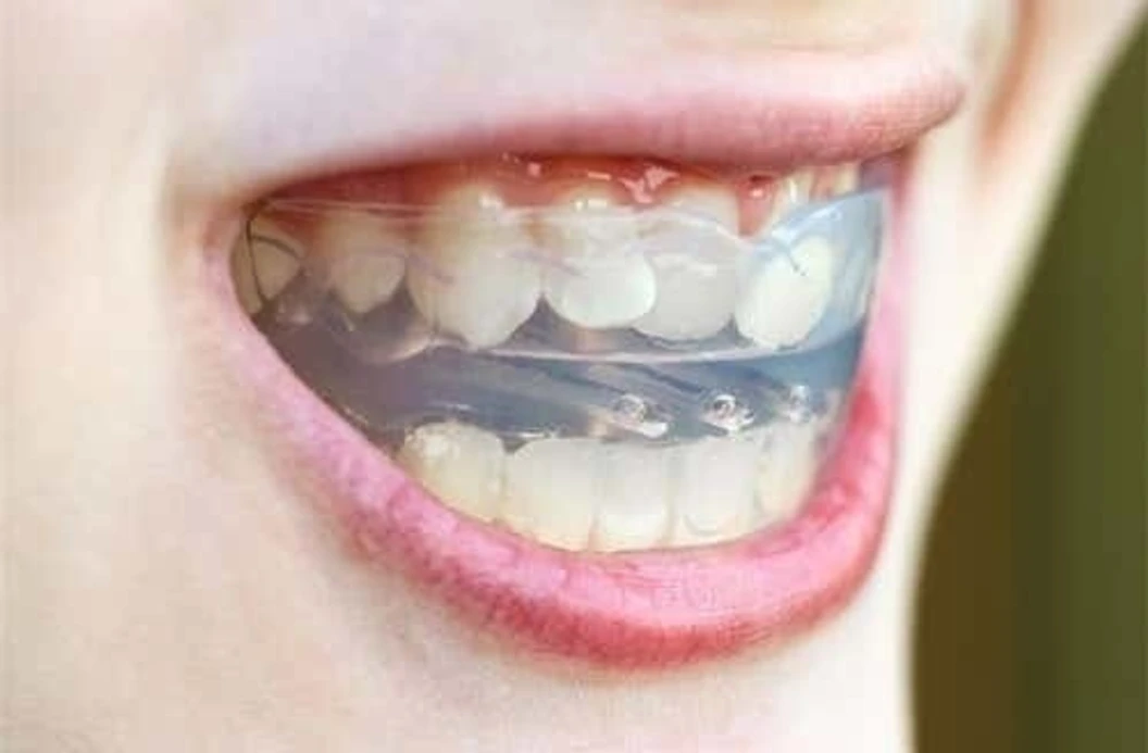 จัดฟันใส Invisalign Full Comprehensive ฟันบนและล่าง