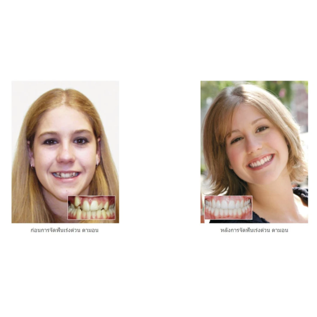 จัดฟันลวด Damon Q