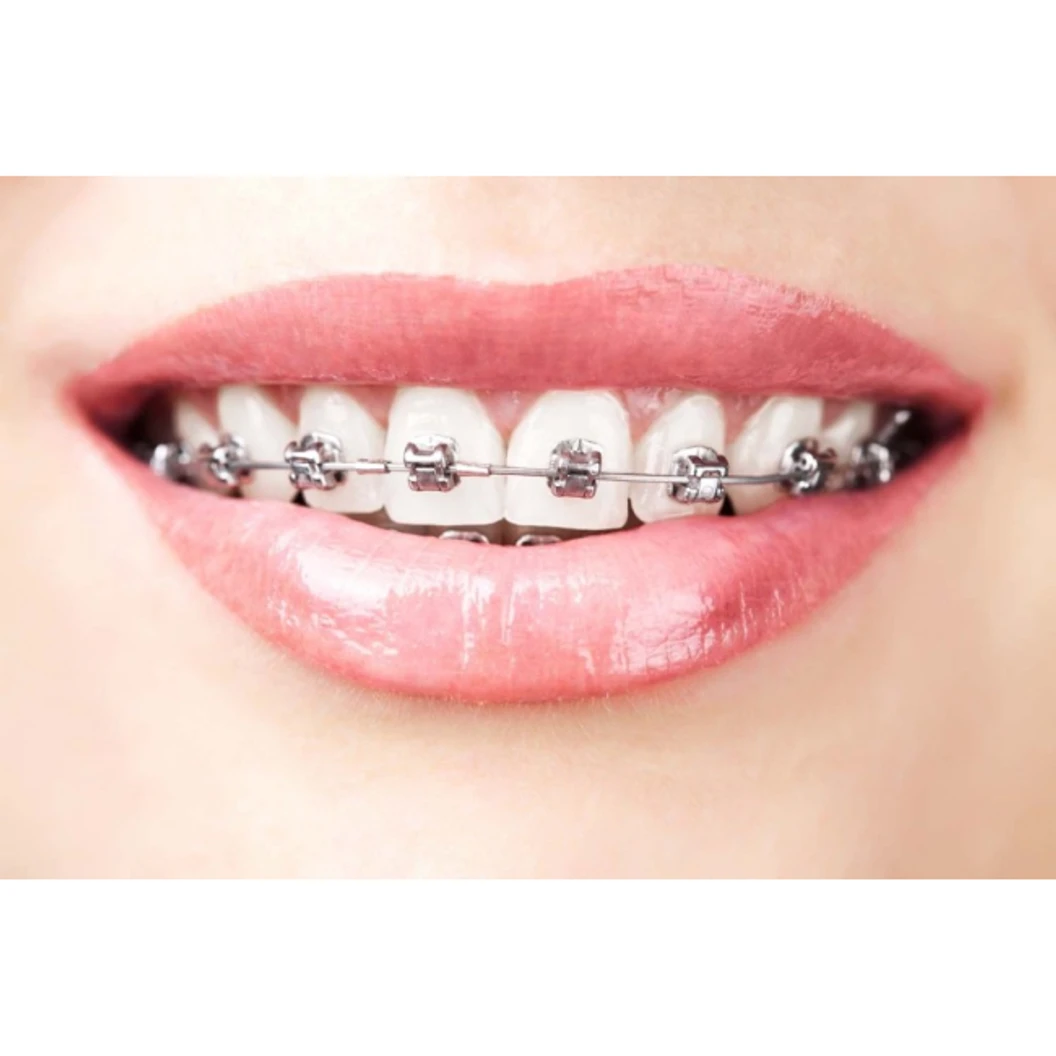 จัดฟันลวด Damon Q