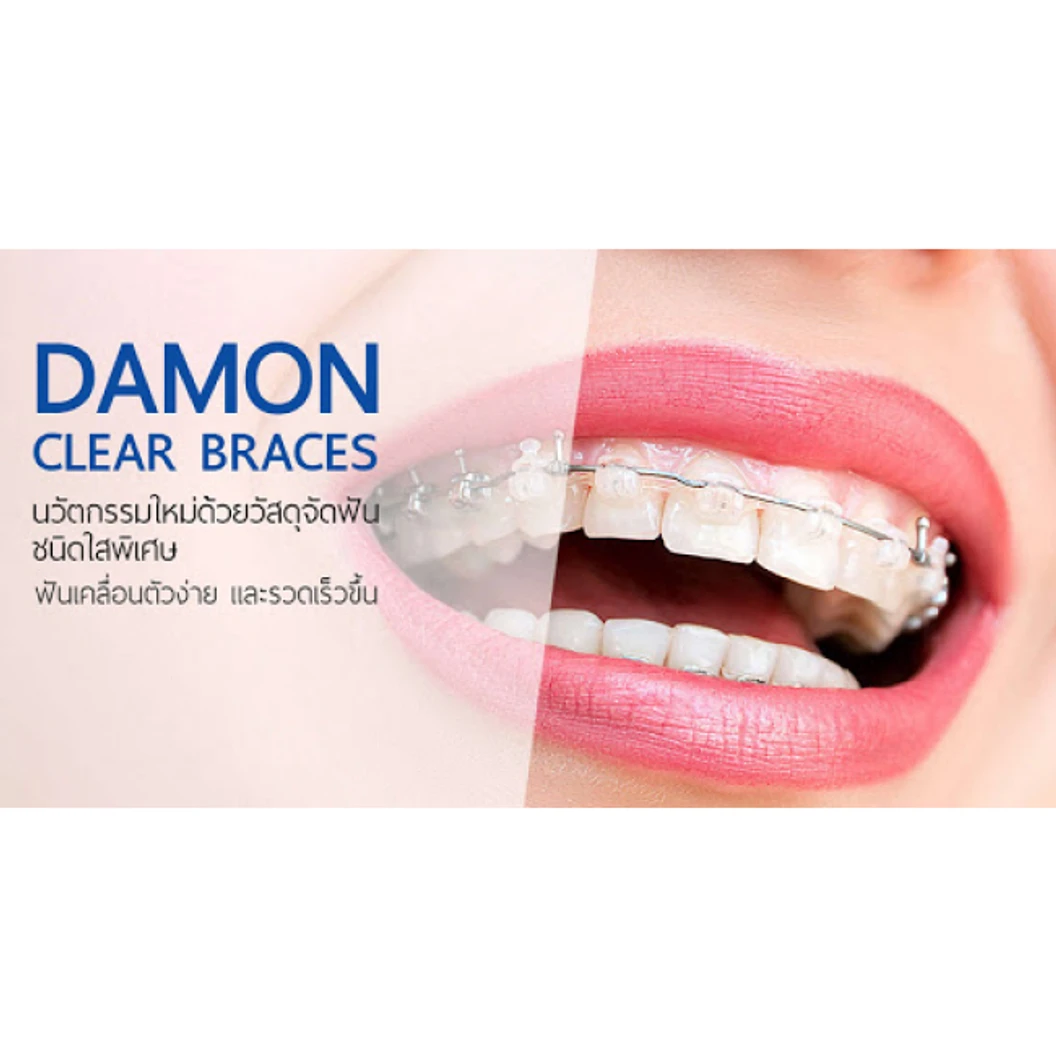 จัดฟันลวด Damon Clear
