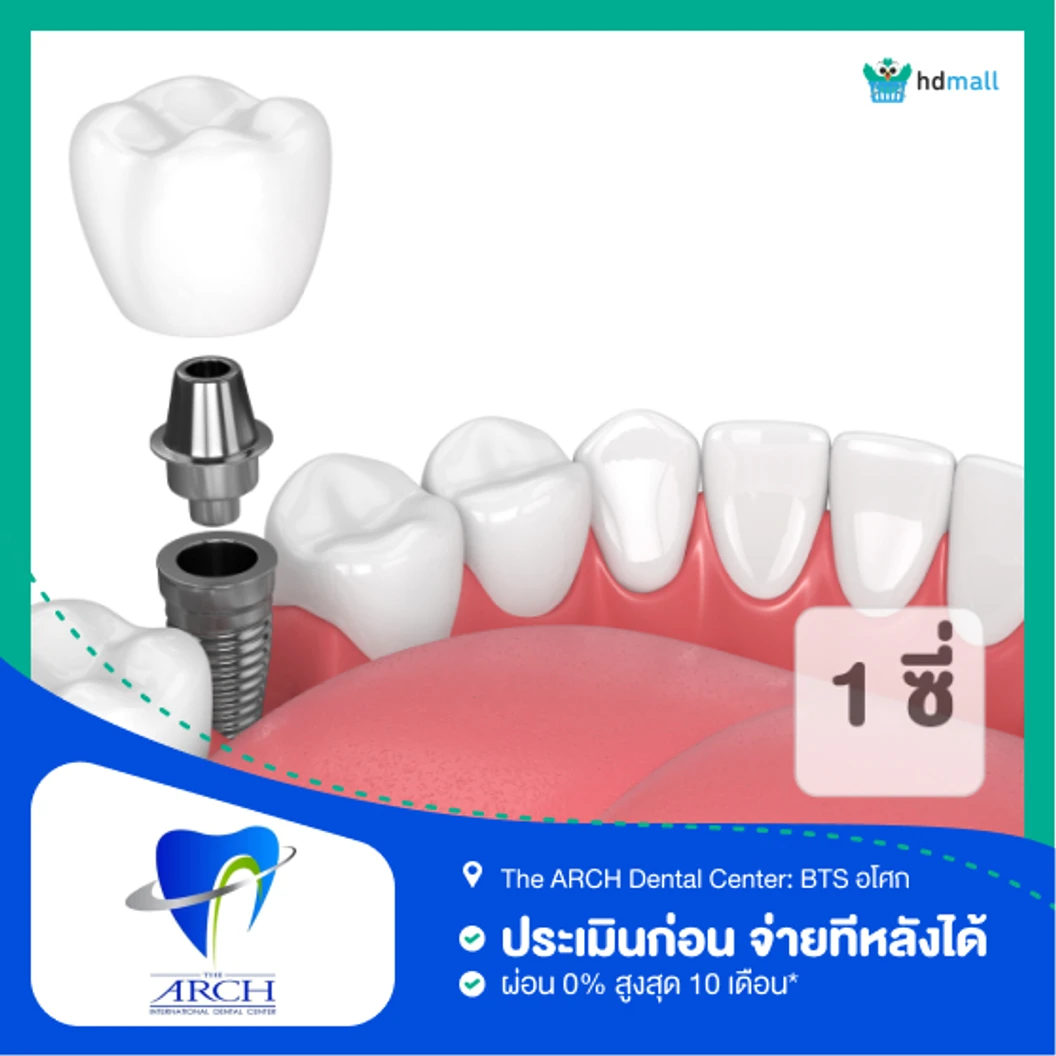 ทำรากฟันเทียม ยี่ห้อ Osstem รวมครอบฟัน 1 ซี่