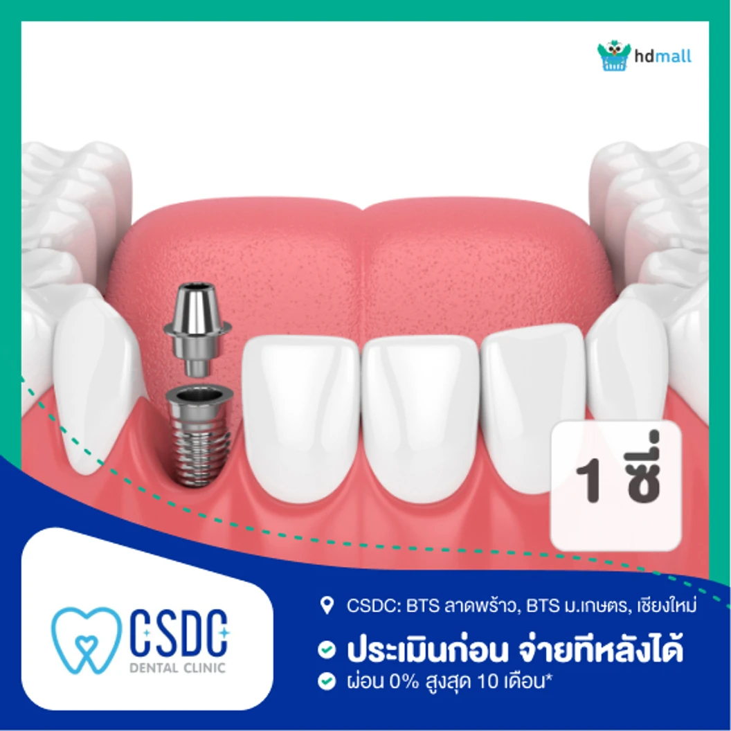 ทำรากฟันเทียม ยี่ห้อ Astra Tech 1 ซี่