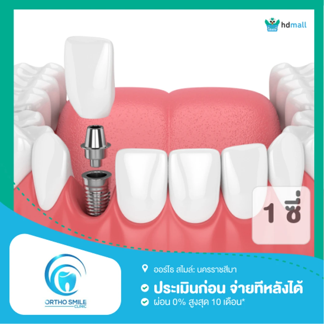 ทำรากฟันเทียม ยี่ห้อ SIC รวมครอบฟัน 1 ซี่