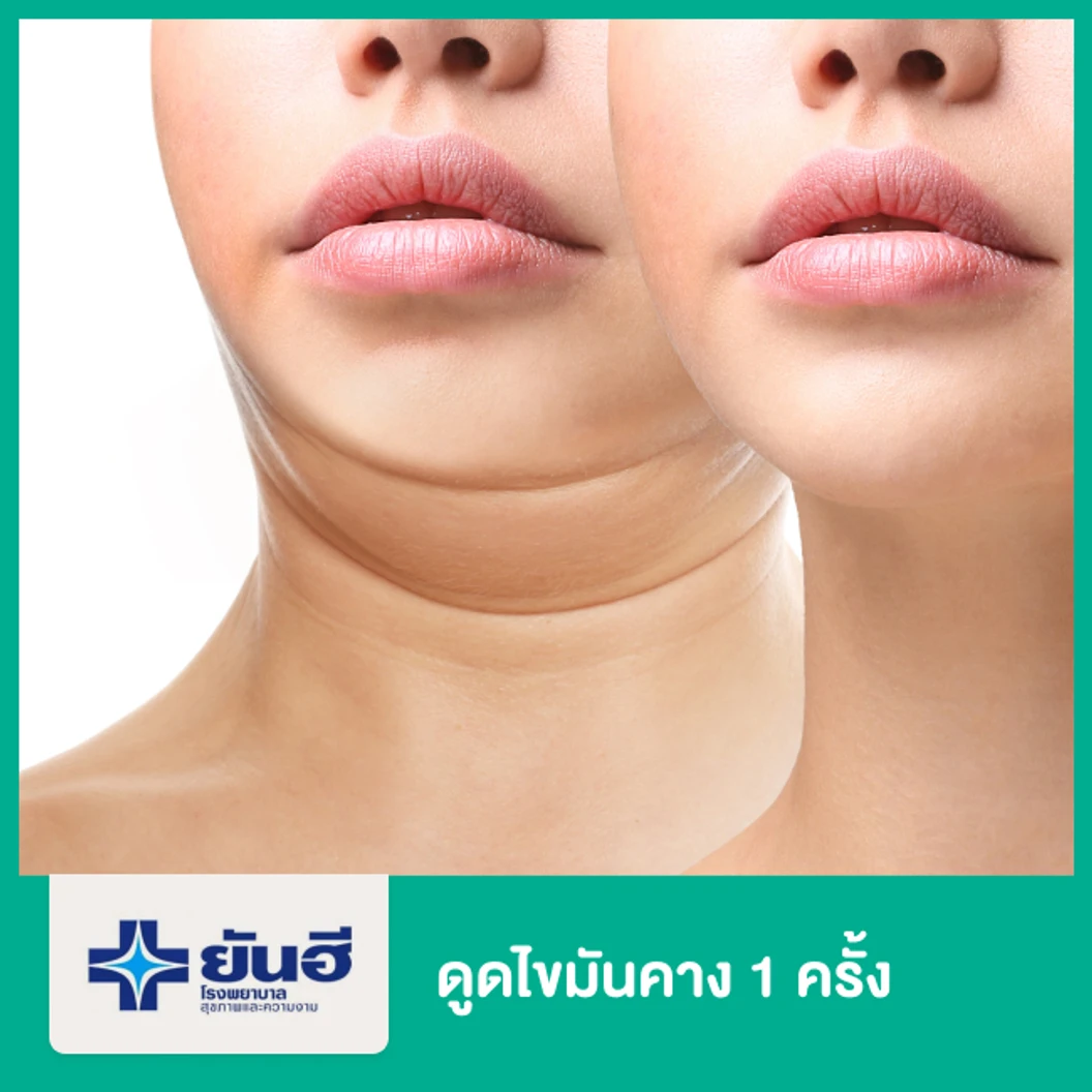 ดูดไขมันคาง 1 ครั้ง