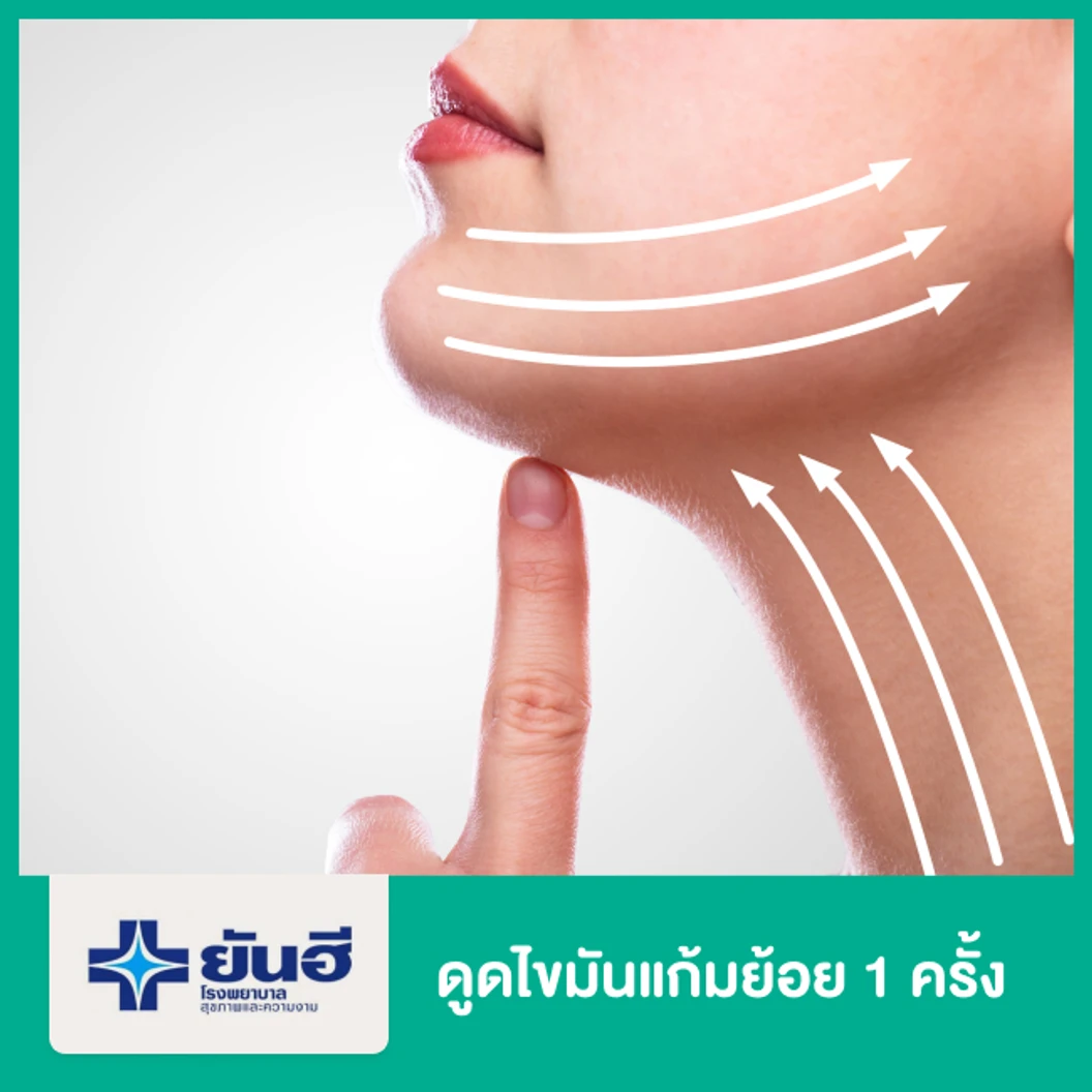ดูดไขมันแก้มย้อย 1 ครั้ง