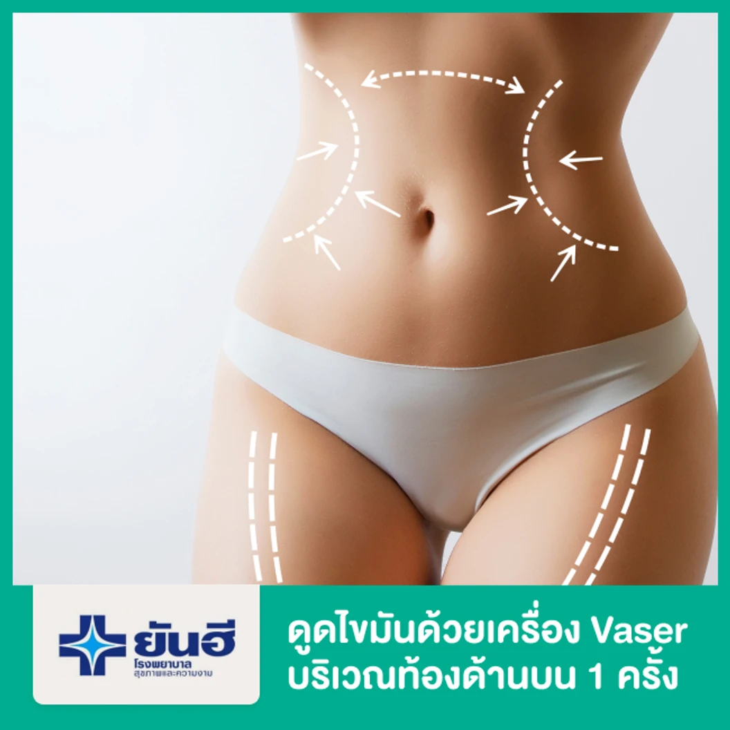 โปรแกรมดูดไขมันด้วยเครื่อง Vaser บริเวณท้องด้านบน 1 ครั้ง