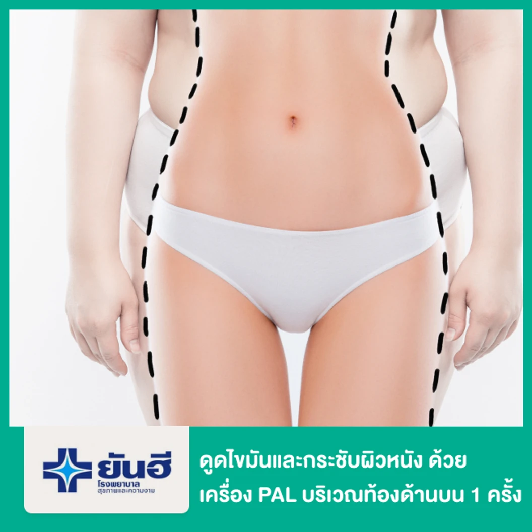 โปรแกรมดูดไขมันและกระชับผิวหนัง ด้วยเครื่อง PAL และ Renuvion บริเวณท้องด้านบน 1 ครั้ง
