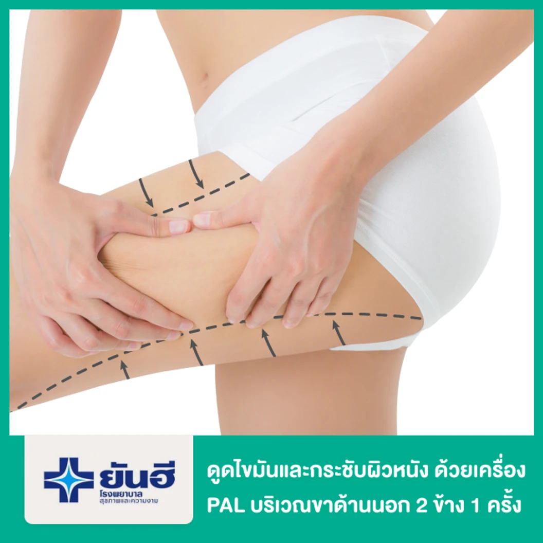 โปรแกรมดูดไขมันและกระชับผิวหนัง ด้วยเครื่อง PAL และ Renuvion บริเวณขาด้านนอก 2 ข้าง 1 ครั้ง