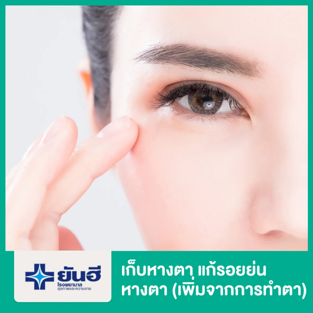 เก็บหางตา แก้รอยย่นหางตา (เพิ่มจากการทำตา)