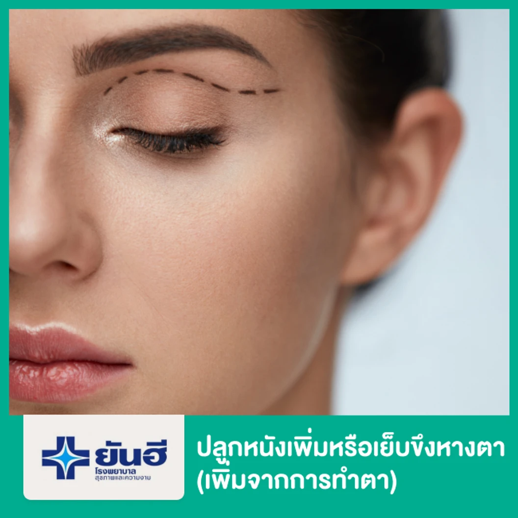 ปลูกหนังเพิ่มหรือเย็บขึงหางตา (เพิ่มจากการทำตา)