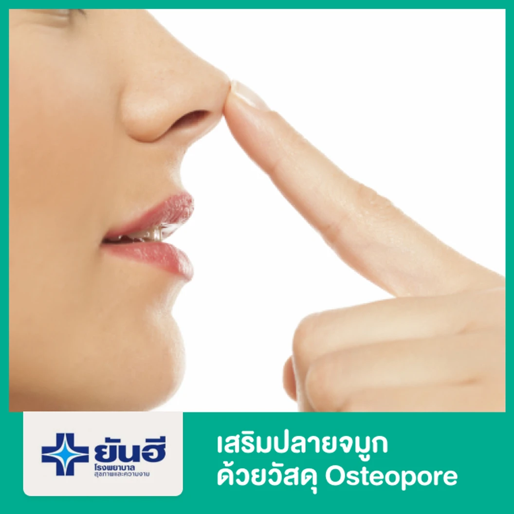 เสริมปลายจมูกด้วยวัสดุ Osteopore (เพิ่มจากเสริมจมูก)
