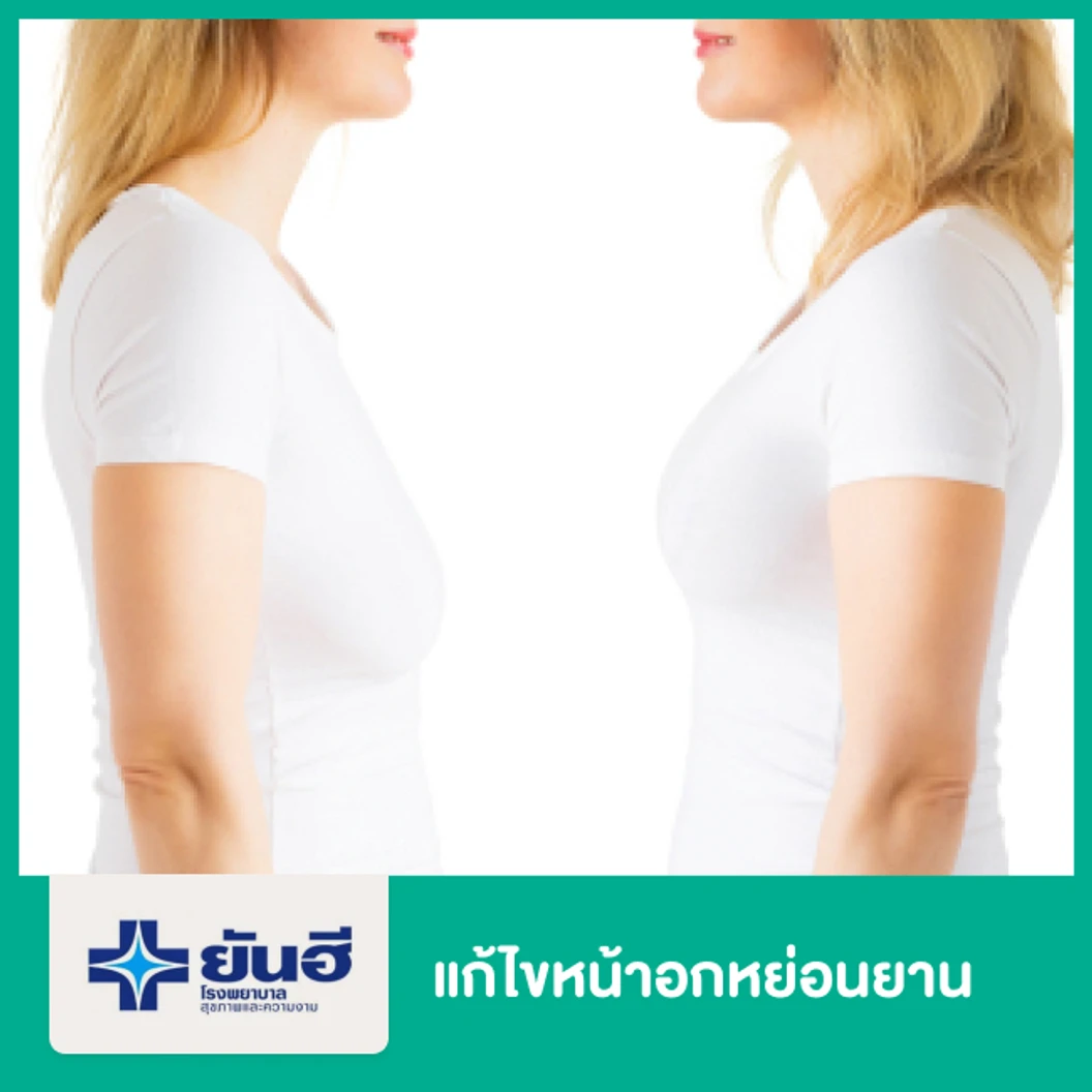 แก้ไขหน้าอกหย่อนยาน(มาก) พักรพ. 1 คืน สำหรับเคสทำครั้งแรก