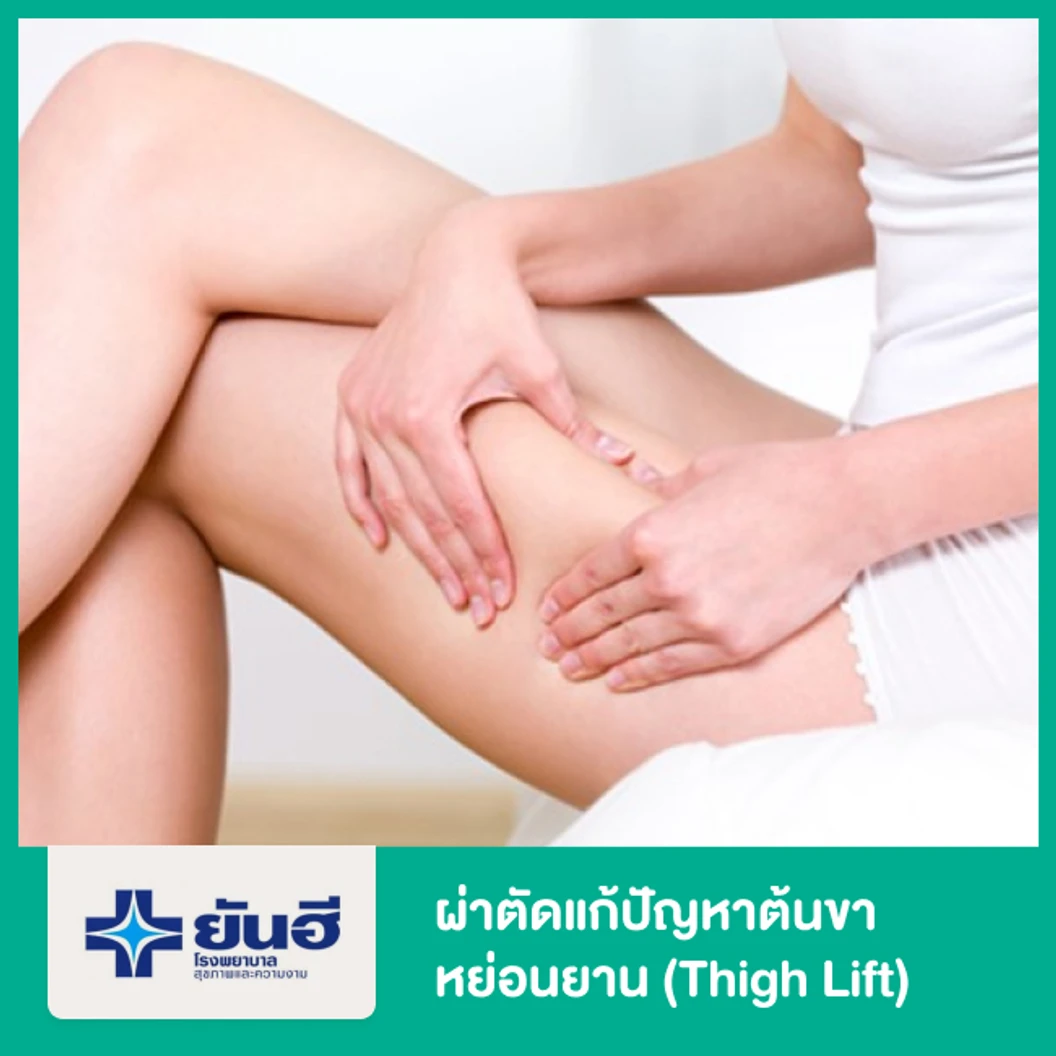 ผ่าตัดแก้ปัญหาต้นขาหย่อนยาน (Thigh Lift) นอนพักที่รพ. 2 คืน