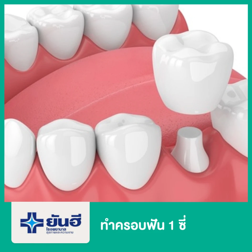 ทำครอบฟัน 1 ซี่