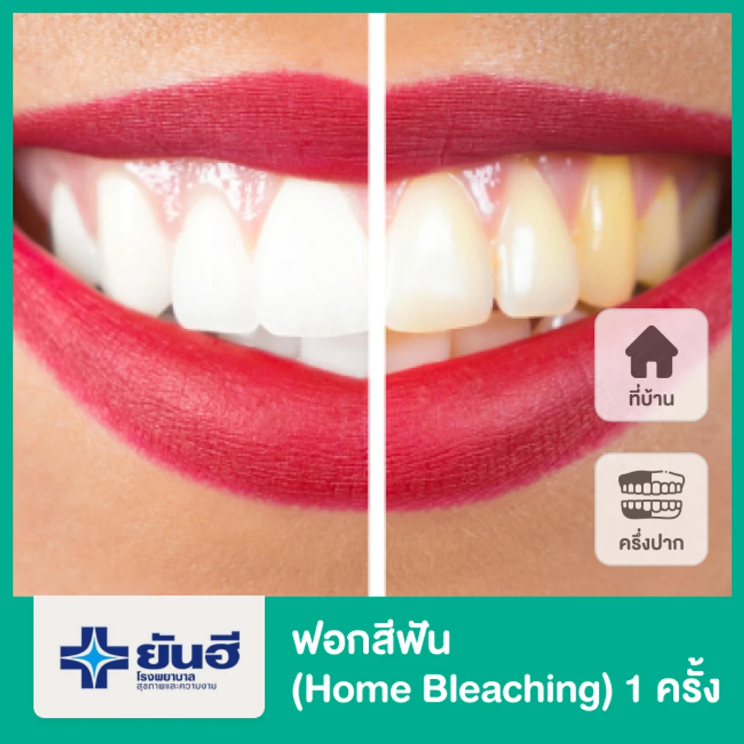 ฟอกสีฟัน (Home Bleaching) ครึ่งปาก 1 ครั้ง
