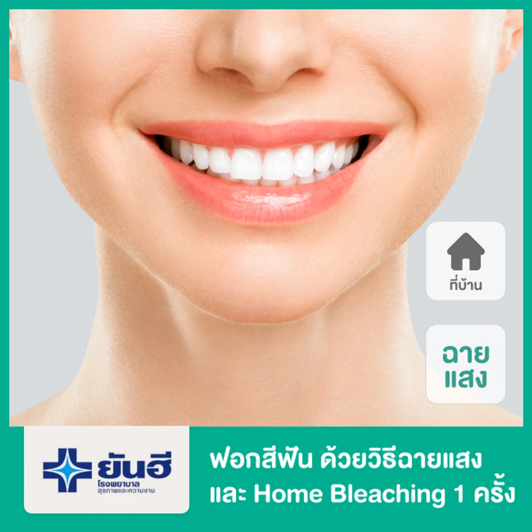 ฟอกสีฟัน ด้วยวิธีฉายแสง และ Home Bleaching 1 ครั้ง