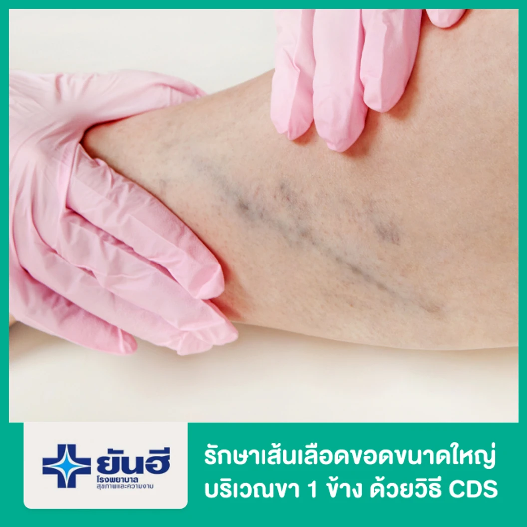 รักษาเส้นเลือดขอดขนาดใหญ่บริเวณขา 1 ข้าง ด้วยวิธี CDS