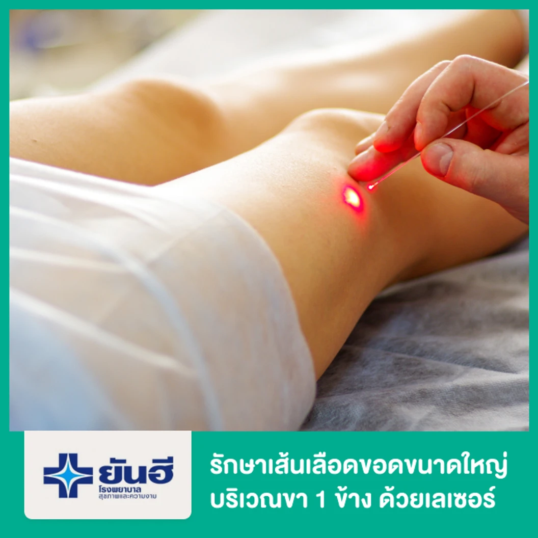 รักษาเส้นเลือดขอดขนาดใหญ่บริเวณขา 1 ข้าง ด้วยเลเซอร์