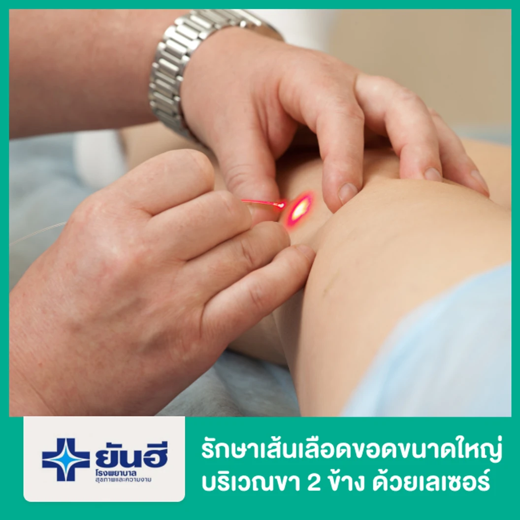 รักษาเส้นเลือดขอดขนาดใหญ่บริเวณขา 2 ข้าง ด้วยเลเซอร์