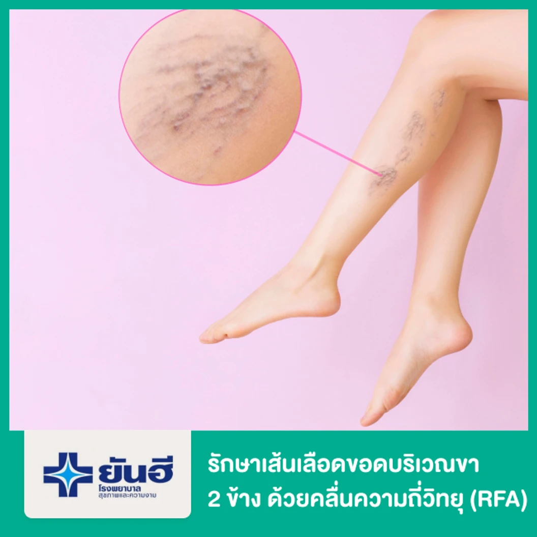 รักษาเส้นเลือดขอดบริเวณขา 2 ข้าง ด้วยคลื่นความถี่วิทยุ (RFA)