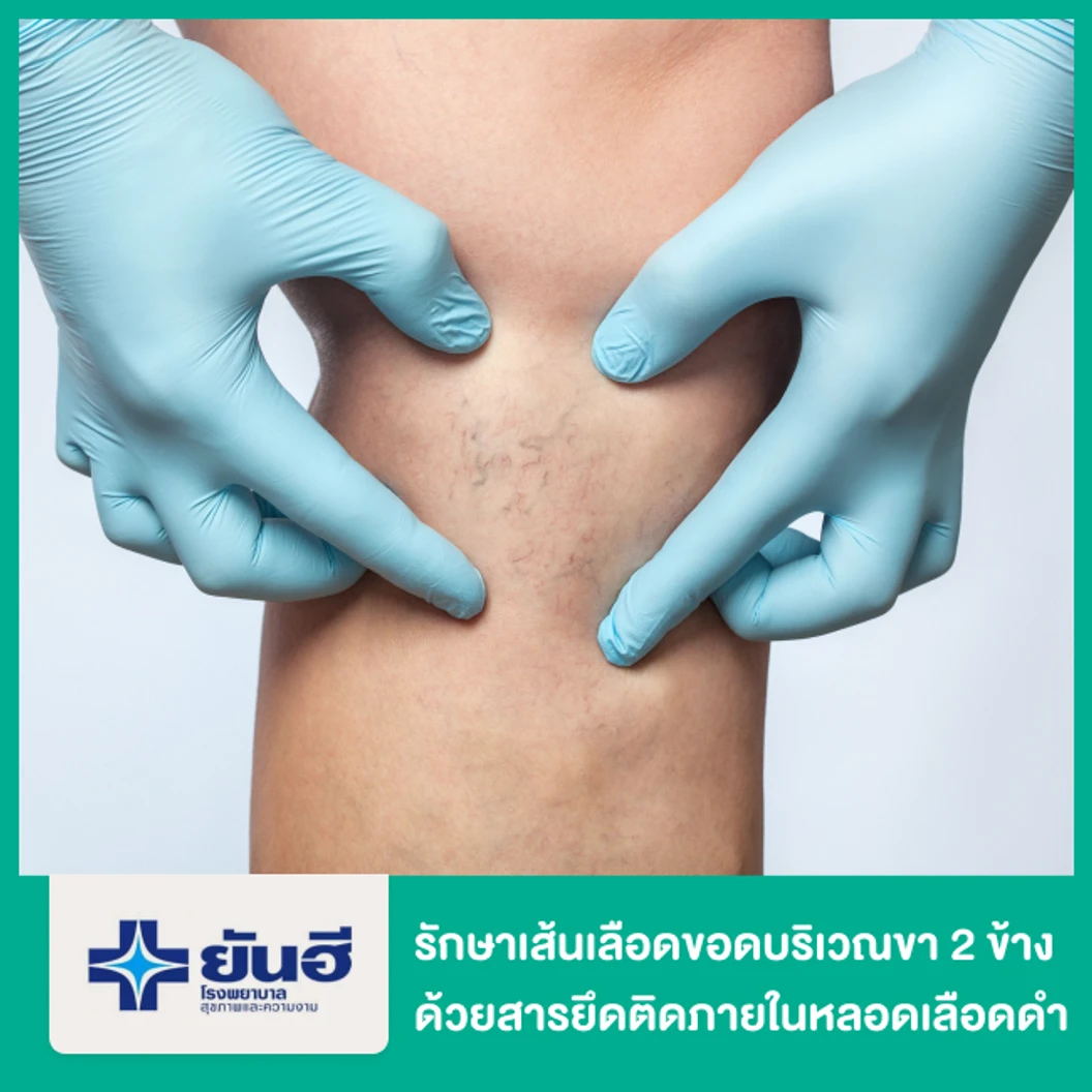 รักษาเส้นเลือดขอดบริเวณขา 2 ข้าง ด้วยสารยึดติดภายในหลอดเลือดดำ