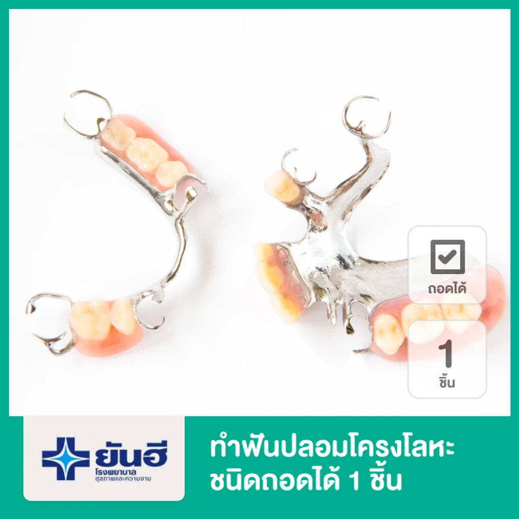 ทำฟันปลอมโครงโลหะ ชนิดถอดได้ 1 ชิ้น