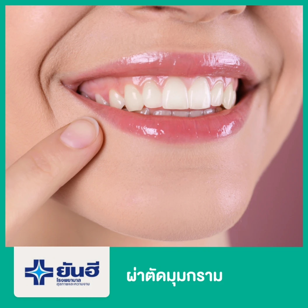 ผ่าตัดมุมกราม กรณีทำร่วมกับการจัดฟัน