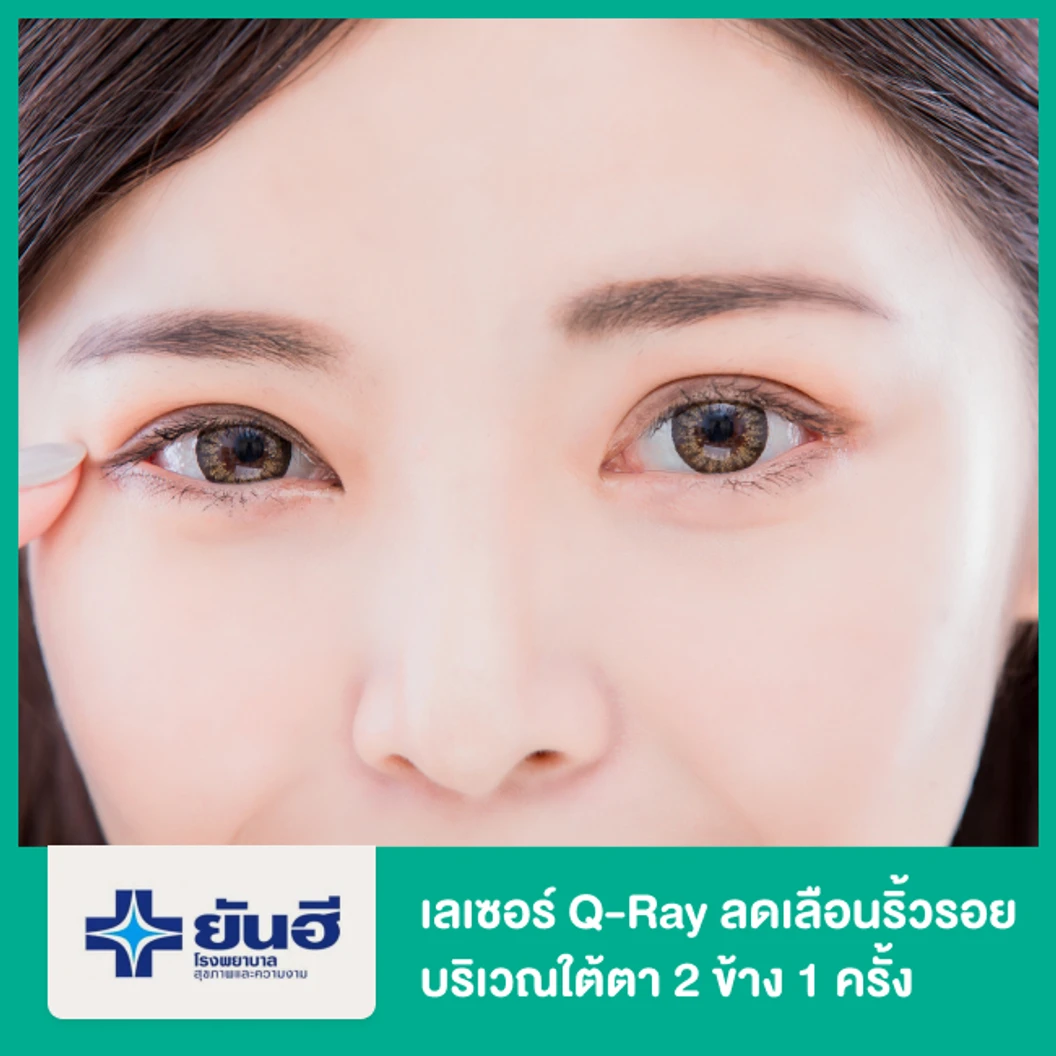 เลเซอร์ Q-Ray ลดเลือนริ้วรอย บริเวณใต้ตา 2 ข้าง 1 ครั้ง
