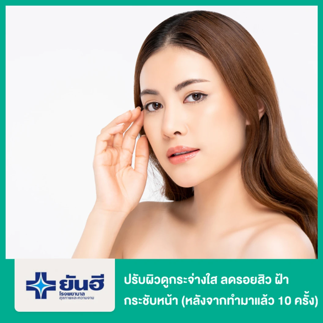 ปรับผิวดูกระจ่างใส ลดรอยสิว ฝ้า กระชับหน้า ด้วย Phono 1 ครั้ง (หลังจากทำมาแล้ว 10 ครั้ง)
