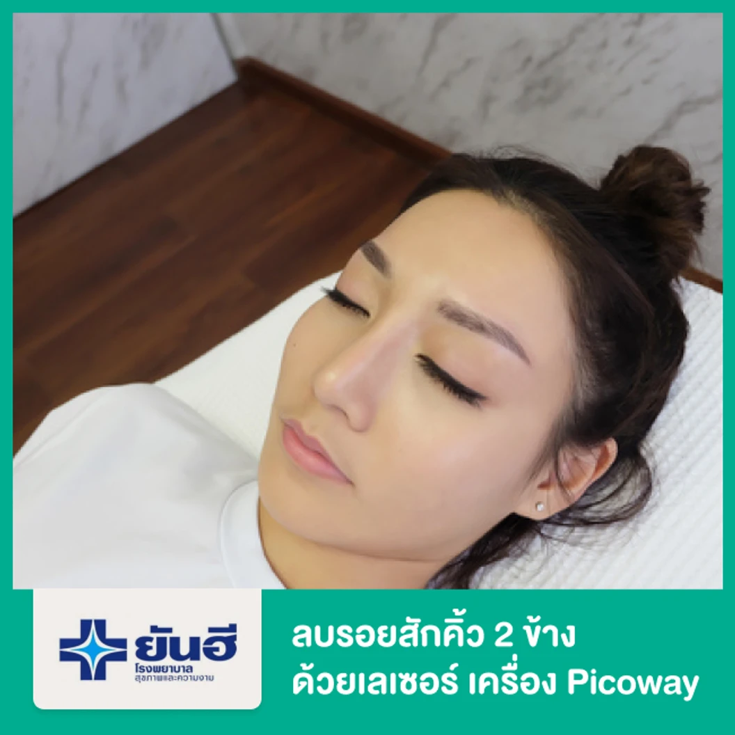 ลบรอยสักคิ้ว 2 ข้าง ด้วยเลเซอร์ เครื่อง Picoway