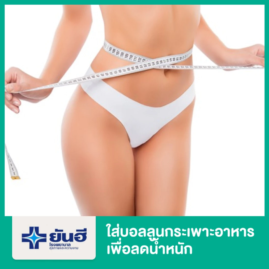 ใส่บอลลูนกระเพาะอาหารเพื่อลดน้ำหนัก (Gastric Balloon) ชนิด 1 ปี พัก 1 คืน