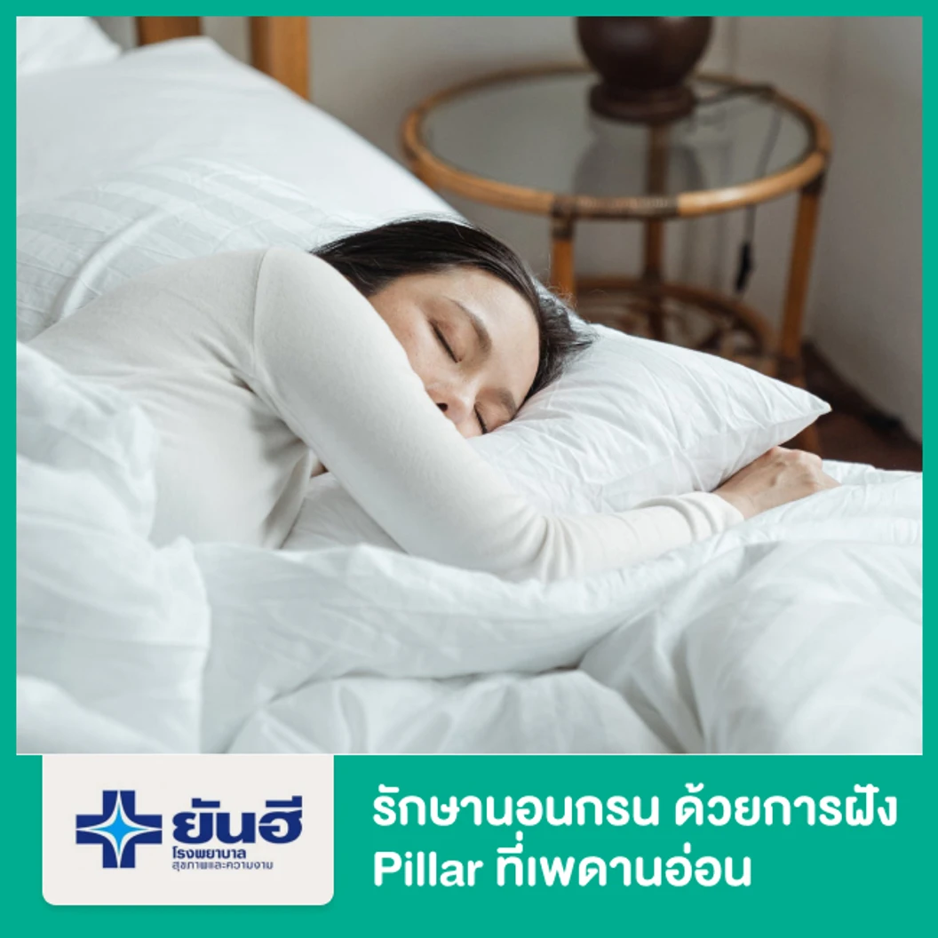 รักษานอนกรน ด้วยการฝัง Pillar ที่เพดานอ่อน