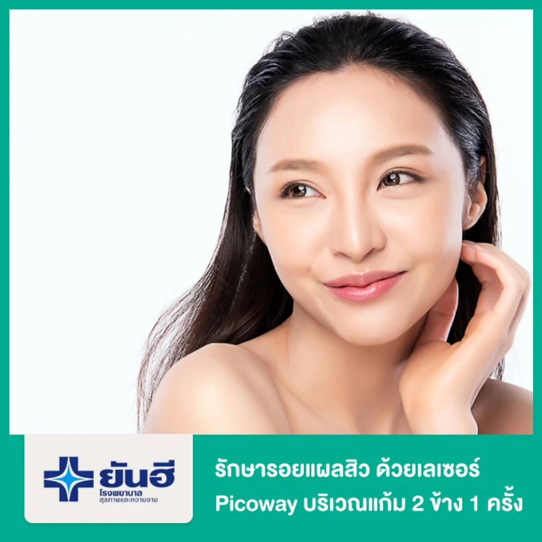 รักษารอยแผลสิว ด้วยเลเซอร์ Picoway บริเวณแก้ม 2 ข้าง 1 ครั้ง