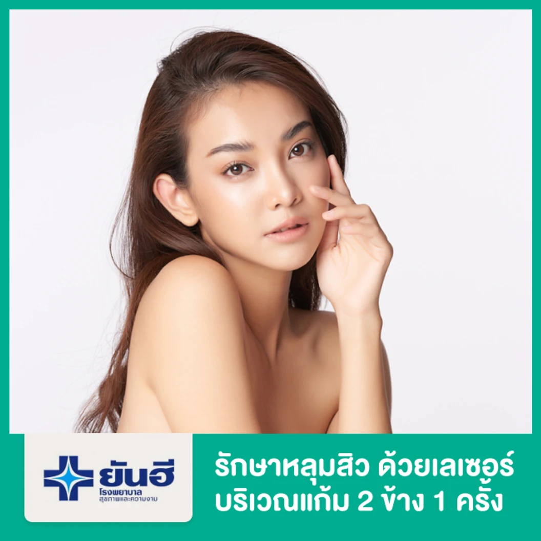 รักษาหลุมสิว ด้วยเลเซอร์ Sublative Rejuvention เครื่อง Ematrix Subeative บริเวณแก้ม 2 ข้าง 1 ครั้ง